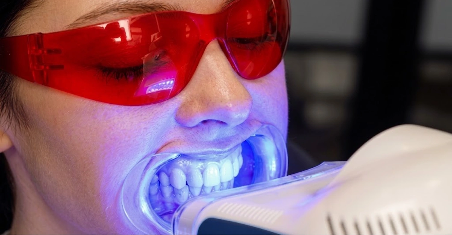 Teeth Whitening Aftercare1